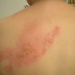 Herpes Zoster