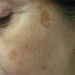 Liver Spots