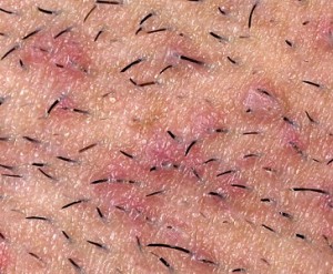 Bumps on bikini area