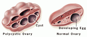 Polycystic ovaries