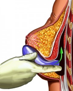 Breast implant