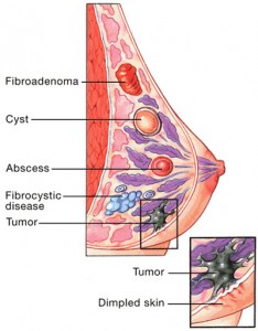 Breast diseases
