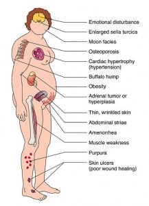 Cushing's Syndrome