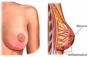 Mastitis