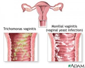 Yellow vaginal discharge