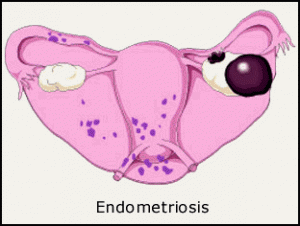 Chocolate cyst - Ovarian endometriosis