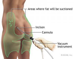 Liposuction