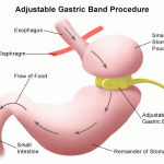 Gastric Banding