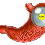 Gastric Balloon