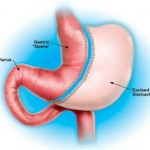 Sleeve Gastrectomy