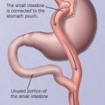 Biliopancreatic Diversion