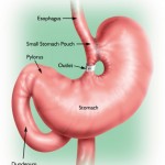 Obesity surgery - Gastroplasty