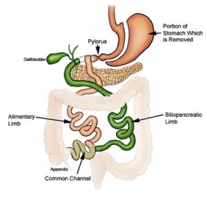 Duodenal switch