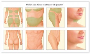 Body contouring