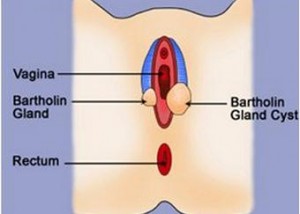 Bartholin Cyst causes and symptoms