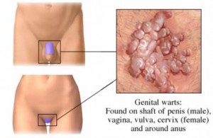 HPV - Genital warts