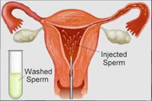 Artificial Intrauterine Insemination