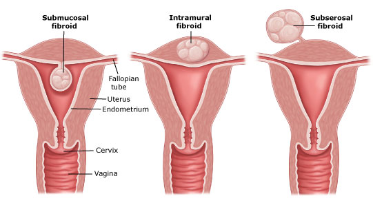 Fibroids