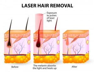 Laser hair removal