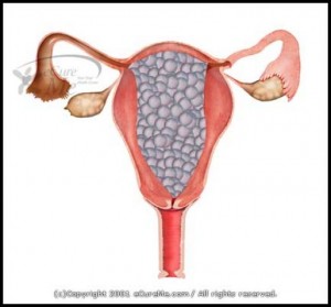 Molar pregnancy