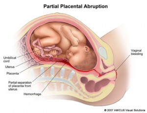 Placental Abruption