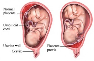 Placenta Previa