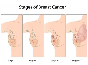 Breast cancer stages