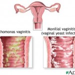 Yellow vaginal discharge