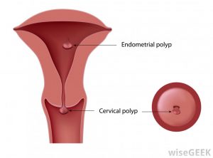 Cervical and uterine polyps