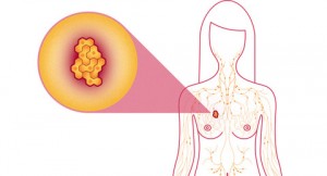 Signs of breast cancer