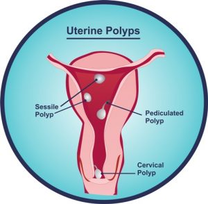 Uterine polyps