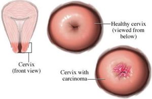 Cervical cancer