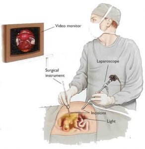 Endometriosis laparoscopy