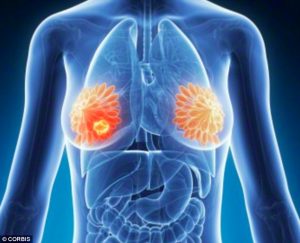 Breast cancer hidden signs