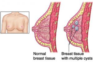 Fibrocystic breasts