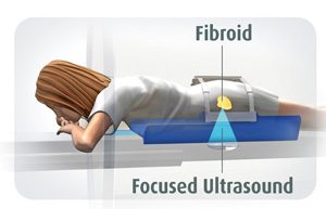 Focused ultrasound surgery