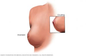 Inverted nipple risks