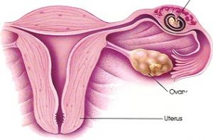 Tubal pregnancy
