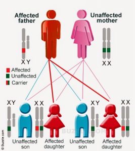 Swyer syndrome