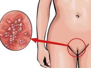 Recurrent genital herpes