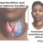 HYPERTHYROIDISM