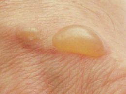 Pustules vaginales