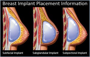 Implants mammaires