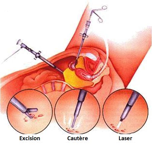 comment traiter endometriose