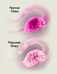 Règles irrégulières - Syndrome Polycystique Ovarien