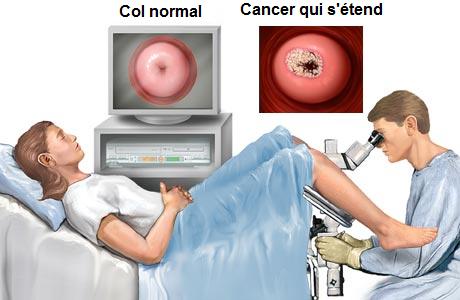 EXAMEN PELVIEN - Le frottis