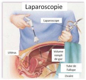 ENDOMÉTRIOSE et LAPAROSCOPIE