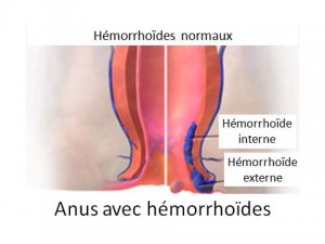 Hémorroïdes