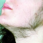Hirsutisme