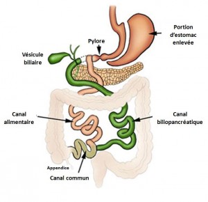 Commutateur duodénal